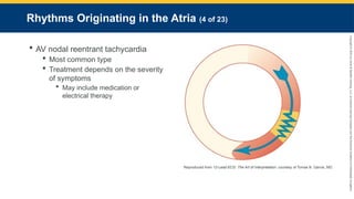 Copyright
©
2023
by
Jones
&
Bartlett
Learning,
LLC,
an
Ascend
Learning
Company
and
the
American
Academy
of
Orthopaedic
Surgeons.
Rhythms Originating in the Atria (4 of 23)
 AV nodal reentrant tachycardia
 Most common type
 Treatment depends on the severity
of symptoms
 May include medication or
electrical therapy
Reproduced from 12-Lead ECG: The Art of Interpretation, courtesy of Tomas B. Garcia, MD.
 