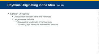 Copyright
©
2023
by
Jones
&
Bartlett
Learning,
LLC,
an
Ascend
Learning
Company
and
the
American
Academy
of
Orthopaedic
Surgeons.
Rhythms Originating in the Atria (5 of 23)
 Cannon “A” waves
 Dissociation between atria and ventricles
 Larger waves indicate:
 Deteriorating functionality of right ventricle
 Increasing right ventricular end-diastolic pressure
 