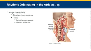 Copyright
©
2023
by
Jones
&
Bartlett
Learning,
LLC,
an
Ascend
Learning
Company
and
the
American
Academy
of
Orthopaedic
Surgeons.
Rhythms Originating in the Atria (10 of 23)
 Vagal maneuvers
 Stimulate baroreceptors
 Types:
 Carotid sinus massage
 Valsalva maneuver
© Jones & Bartlett Learning.
 