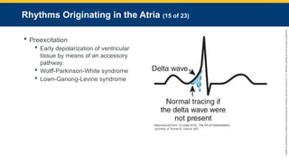 Copyright
©
2023
by
Jones
&
Bartlett
Learning,
LLC,
an
Ascend
Learning
Company
and
the
American
Academy
of
Orthopaedic
Surgeons.
Rhythms Originating in the Atria (15 of 23)
 Preexcitation
 Early depolarization of ventricular
tissue by means of an accessory
pathway.
 Wolff-Parkinson-White syndrome
 Lown-Ganong-Levine syndrome
Reproduced from 12-Lead ECG: The Art of Interpretation,
courtesy of Tomas B. Garcia, MD.
 