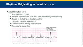 Copyright
©
2023
by
Jones
&
Bartlett
Learning,
LLC,
an
Ascend
Learning
Company
and
the
American
Academy
of
Orthopaedic
Surgeons.
Rhythms Originating in the Atria (17 of 23)
 Atrial fibrillation (AF)
 Atria fibrillate or quiver
 Random depolarization from atria cells depolarizing independently
 Results in fibrillating or chaotic baseline
 Irregularly irregular appearance
 Common rhythm among older patients
 Tendency to cause clots
Reproduced from 12-Lead ECG: The Art of Interpretation, courtesy of Tomas B. Garcia, MD.
 