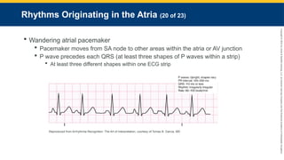 Copyright
©
2023
by
Jones
&
Bartlett
Learning,
LLC,
an
Ascend
Learning
Company
and
the
American
Academy
of
Orthopaedic
Surgeons.
Rhythms Originating in the Atria (20 of 23)
 Wandering atrial pacemaker
 Pacemaker moves from SA node to other areas within the atria or AV junction
 P wave precedes each QRS (at least three shapes of P waves within a strip)
 At least three different shapes within one ECG strip
Reproduced from Arrhythmia Recognition: The Art of Interpretation, courtesy of Tomas B. Garcia, MD
 