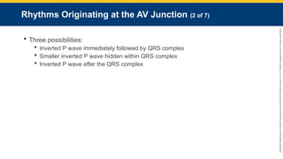 Copyright
©
2023
by
Jones
&
Bartlett
Learning,
LLC,
an
Ascend
Learning
Company
and
the
American
Academy
of
Orthopaedic
Surgeons.
Rhythms Originating at the AV Junction (2 of 7)
 Three possibilities:
 Inverted P wave immediately followed by QRS complex
 Smaller inverted P wave hidden within QRS complex
 Inverted P wave after the QRS complex
 