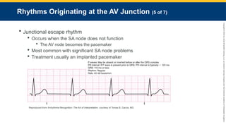 Copyright
©
2023
by
Jones
&
Bartlett
Learning,
LLC,
an
Ascend
Learning
Company
and
the
American
Academy
of
Orthopaedic
Surgeons.
Rhythms Originating at the AV Junction (5 of 7)
 Junctional escape rhythm
 Occurs when the SA node does not function
 The AV node becomes the pacemaker
 Most common with significant SA node problems
 Treatment usually an implanted pacemaker
Reproduced from Arrhythmia Recognition: The Art of Interpretation, courtesy of Tomas B. Garcia, MD.
 