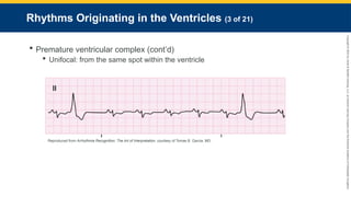 Copyright
©
2023
by
Jones
&
Bartlett
Learning,
LLC,
an
Ascend
Learning
Company
and
the
American
Academy
of
Orthopaedic
Surgeons.
Rhythms Originating in the Ventricles (3 of 21)
 Premature ventricular complex (cont’d)
 Unifocal: from the same spot within the ventricle
Reproduced from Arrhythmia Recognition: The Art of Interpretation, courtesy of Tomas B. Garcia, MD.
 