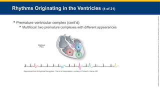 Copyright
©
2023
by
Jones
&
Bartlett
Learning,
LLC,
an
Ascend
Learning
Company
and
the
American
Academy
of
Orthopaedic
Surgeons.
Rhythms Originating in the Ventricles (4 of 21)
 Premature ventricular complex (cont’d)
 Multifocal: two premature complexes with different appearances
Reproduced from Arrhythmia Recognition: The Art of Interpretation, courtesy of Tomas B. Garcia, MD
 