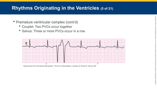 Copyright
©
2023
by
Jones
&
Bartlett
Learning,
LLC,
an
Ascend
Learning
Company
and
the
American
Academy
of
Orthopaedic
Surgeons.
Rhythms Originating in the Ventricles (5 of 21)
 Premature ventricular complex (cont’d)
 Couplet: Two PVCs occur together
 Salvos: Three or more PVCs occur in a row
Reproduced from Arrhythmia Recognition: The Art of Interpretation, courtesy of Tomas B. Garcia, MD
 