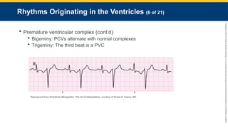 Copyright
©
2023
by
Jones
&
Bartlett
Learning,
LLC,
an
Ascend
Learning
Company
and
the
American
Academy
of
Orthopaedic
Surgeons.
Rhythms Originating in the Ventricles (6 of 21)
 Premature ventricular complex (cont’d)
 Bigeminy: PCVs alternate with normal complexes
 Trigeminy: The third beat is a PVC
Reproduced from Arrhythmia Recognition: The Art of Interpretation, courtesy of Tomas B. Garcia, MD.
 