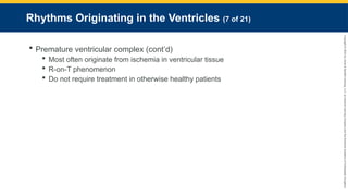 Copyright
©
2023
by
Jones
&
Bartlett
Learning,
LLC,
an
Ascend
Learning
Company
and
the
American
Academy
of
Orthopaedic
Surgeons.
Rhythms Originating in the Ventricles (7 of 21)
 Premature ventricular complex (cont’d)
 Most often originate from ischemia in ventricular tissue
 R-on-T phenomenon
 Do not require treatment in otherwise healthy patients
 