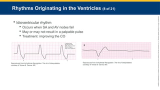 Copyright
©
2023
by
Jones
&
Bartlett
Learning,
LLC,
an
Ascend
Learning
Company
and
the
American
Academy
of
Orthopaedic
Surgeons.
Rhythms Originating in the Ventricles (8 of 21)
 Idioventricular rhythm
 Occurs when SA and AV nodes fail
 May or may not result in a palpable pulse
 Treatment: improving the CO
Reproduced from Arrhythmia Recognition: The Art of Interpretation,
courtesy of Tomas B. Garcia, MD.
Reproduced from Arrhythmia Recognition: The Art of Interpretation,
courtesy of Tomas B. Garcia, MD
 
