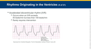 Copyright
©
2023
by
Jones
&
Bartlett
Learning,
LLC,
an
Ascend
Learning
Company
and
the
American
Academy
of
Orthopaedic
Surgeons.
Rhythms Originating in the Ventricles (9 of 21)
 Accelerated idioventricular rhythm (IVR)
 Occurs when an IVR exceeds
40 beats/min but less than 100 beats/min
 Rarely requires intervention
Reproduced from Arrhythmia Recognition: The Art of Interpretation, courtesy of Tomas B. Garcia, MD.
 