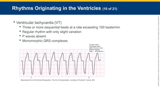 Copyright
©
2023
by
Jones
&
Bartlett
Learning,
LLC,
an
Ascend
Learning
Company
and
the
American
Academy
of
Orthopaedic
Surgeons.
Rhythms Originating in the Ventricles (10 of 21)
 Ventricular tachycardia (VT)
 Three or more sequential beats at a rate exceeding 100 beats/min
 Regular rhythm with only slight variation
 P waves absent
 Monomorphic QRS complexes
Reproduced from Arrhythmia Recognition: The Art of Interpretation, courtesy of Tomas B. Garcia, MD.
 