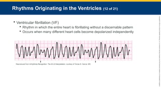 Copyright
©
2023
by
Jones
&
Bartlett
Learning,
LLC,
an
Ascend
Learning
Company
and
the
American
Academy
of
Orthopaedic
Surgeons.
Rhythms Originating in the Ventricles (12 of 21)
 Ventricular fibrillation (VF)
 Rhythm in which the entire heart is fibrillating without a discernable pattern
 Occurs when many different heart cells become depolarized independently
Reproduced from Arrhythmia Recognition: The Art of Interpretation, courtesy of Tomas B. Garcia, MD.
 