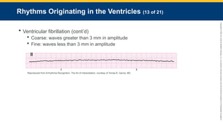 Copyright
©
2023
by
Jones
&
Bartlett
Learning,
LLC,
an
Ascend
Learning
Company
and
the
American
Academy
of
Orthopaedic
Surgeons.
Rhythms Originating in the Ventricles (13 of 21)
 Ventricular fibrillation (cont’d)
 Coarse: waves greater than 3 mm in amplitude
 Fine: waves less than 3 mm in amplitude
Reproduced from Arrhythmia Recognition: The Art of Interpretation, courtesy of Tomas B. Garcia, MD.
 