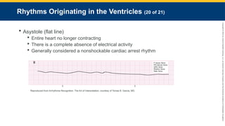 Copyright
©
2023
by
Jones
&
Bartlett
Learning,
LLC,
an
Ascend
Learning
Company
and
the
American
Academy
of
Orthopaedic
Surgeons.
Rhythms Originating in the Ventricles (20 of 21)
 Asystole (flat line)
 Entire heart no longer contracting
 There is a complete absence of electrical activity
 Generally considered a nonshockable cardiac arrest rhythm
Reproduced from Arrhythmia Recognition: The Art of Interpretation, courtesy of Tomas B. Garcia, MD.
 