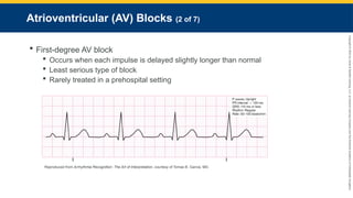 Copyright
©
2023
by
Jones
&
Bartlett
Learning,
LLC,
an
Ascend
Learning
Company
and
the
American
Academy
of
Orthopaedic
Surgeons.
Atrioventricular (AV) Blocks (2 of 7)
 First-degree AV block
 Occurs when each impulse is delayed slightly longer than normal
 Least serious type of block
 Rarely treated in a prehospital setting
Reproduced from Arrhythmia Recognition: The Art of Interpretation, courtesy of Tomas B. Garcia, MD.
 
