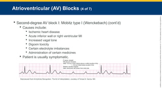 Copyright
©
2023
by
Jones
&
Bartlett
Learning,
LLC,
an
Ascend
Learning
Company
and
the
American
Academy
of
Orthopaedic
Surgeons.
Atrioventricular (AV) Blocks (4 of 7)
 Second-degree AV block I: Mobitz type I (Wenckebach) (cont’d)
 Causes include:
 Ischemic heart disease
 Acute inferior wall or right ventricular MI
 Increased vagal tone
 Digoxin toxicity
 Certain electrolyte imbalances
 Administration of certain medicines
 Patient is usually symptomatic.
Reproduced from Arrhythmia Recognition: The Art of Interpretation, courtesy of Tomas B. Garcia, MD.
 