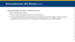 Copyright
©
2023
by
Jones
&
Bartlett
Learning,
LLC,
an
Ascend
Learning
Company
and
the
American
Academy
of
Orthopaedic
Surgeons.
Atrioventricular (AV) Blocks (5 of 7)
 Second-degree AV block II (Mobitz type II)
 More serious than type I
 Occurs when several impulses cannot continue
 An intermittent block characterized by regularly occurring P waves and the abrupt
appearance of at least one P wave that is not followed by a QRS complex
 