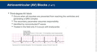 Copyright
©
2023
by
Jones
&
Bartlett
Learning,
LLC,
an
Ascend
Learning
Company
and
the
American
Academy
of
Orthopaedic
Surgeons.
Atrioventricular (AV) Blocks (7 of 7)
 Third-degree AV block
 Occurs when all impulses are prevented from reaching the ventricles and
generating a QRS complex
 The secondary pacemaker assumes responsibility
 Identified by nonconducted P waves
 Treated in the field only if it occurs with bradycardia
Reproduced from Arrhythmia Recognition: The Art of Interpretation, courtesy of Tomas B. Garcia, MD.
 