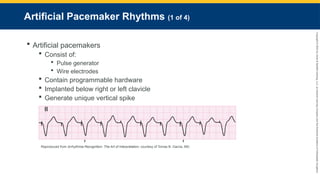 Copyright
©
2023
by
Jones
&
Bartlett
Learning,
LLC,
an
Ascend
Learning
Company
and
the
American
Academy
of
Orthopaedic
Surgeons.
Artificial Pacemaker Rhythms (1 of 4)
 Artificial pacemakers
 Consist of:
 Pulse generator
 Wire electrodes
 Contain programmable hardware
 Implanted below right or left clavicle
 Generate unique vertical spike
Reproduced from Arrhythmia Recognition: The Art of Interpretation, courtesy of Tomas B. Garcia, MD.
 