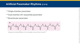 Copyright
©
2023
by
Jones
&
Bartlett
Learning,
LLC,
an
Ascend
Learning
Company
and
the
American
Academy
of
Orthopaedic
Surgeons.
Artificial Pacemaker Rhythms (2 of 4)
 Single-chamber pacemaker
 Dual-chamber (AV sequential) pacemaker
 Biventricular pacemaker
Reproduced from Arrhythmia Recognition: The Art of Interpretation, courtesy of Tomas B. Garcia, MD.
 