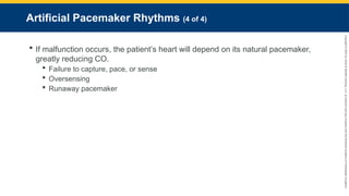 Copyright
©
2023
by
Jones
&
Bartlett
Learning,
LLC,
an
Ascend
Learning
Company
and
the
American
Academy
of
Orthopaedic
Surgeons.
Artificial Pacemaker Rhythms (4 of 4)
 If malfunction occurs, the patient’s heart will depend on its natural pacemaker,
greatly reducing CO.
 Failure to capture, pace, or sense
 Oversensing
 Runaway pacemaker
 