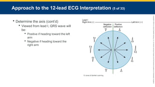 Copyright
©
2023
by
Jones
&
Bartlett
Learning,
LLC,
an
Ascend
Learning
Company
and
the
American
Academy
of
Orthopaedic
Surgeons.
Approach to the 12-lead ECG Interpretation (5 of 33)
 Determine the axis (cont’d)
 Viewed from lead I, QRS wave will
be:
 Positive if heading toward the left
arm
 Negative if heading toward the
right arm
© Jones & Bartlett Learning.
 