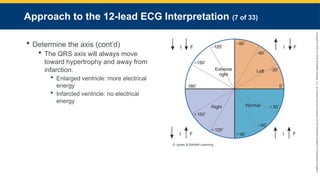 Copyright
©
2023
by
Jones
&
Bartlett
Learning,
LLC,
an
Ascend
Learning
Company
and
the
American
Academy
of
Orthopaedic
Surgeons.
Approach to the 12-lead ECG Interpretation (7 of 33)
 Determine the axis (cont’d)
 The QRS axis will always move
toward hypertrophy and away from
infarction.
 Enlarged ventricle: more electrical
energy
 Infarcted ventricle: no electrical
energy
© Jones & Bartlett Learning.
 