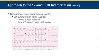 Copyright
©
2023
by
Jones
&
Bartlett
Learning,
LLC,
an
Ascend
Learning
Company
and
the
American
Academy
of
Orthopaedic
Surgeons.
Approach to the 12-lead ECG Interpretation (9 of 33)
 Conduction system disturbances (cont’d)
 Left bundle branch blocks (LBBBs)
 Terminal S wave in lead V1
 Terminal R waves in leads I, aVL, and V6
Reproduced from 12-Lead ECG: The Art of Interpretation, courtesy of Tomas B. Garcia, MD.
 