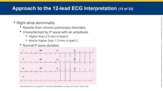 Copyright
©
2023
by
Jones
&
Bartlett
Learning,
LLC,
an
Ascend
Learning
Company
and
the
American
Academy
of
Orthopaedic
Surgeons.
Approach to the 12-lead ECG Interpretation (13 of 33)
 Right atrial abnormality
 Results from chronic pulmonary disorders
 Characterized by P wave with an amplitude:
 Higher than 2.5 mm in lead II
 And/or higher than 1.5 mm in lead V1
 Normal P wave duration
Reproduced from 12-Lead ECG: The Art of Interpretation, courtesy of Tomas B. Garcia, MD.
 