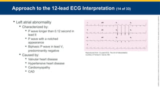 Copyright
©
2023
by
Jones
&
Bartlett
Learning,
LLC,
an
Ascend
Learning
Company
and
the
American
Academy
of
Orthopaedic
Surgeons.
Approach to the 12-lead ECG Interpretation (14 of 33)
 Left atrial abnormality
 Characterized by:
 P wave longer than 0.12 second in
lead II
 P wave with a notched
appearance
 Biphasic P wave in lead V1
predominantly negative
 Caused by:
 Valvular heart disease
 Hypertensive heart disease
 Cardiomyopathy
 CAD
Reproduced from 12-Lead ECG: The Art of Interpretation,
courtesy of Tomas B. Garcia, MD.
 