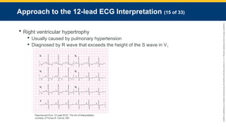 Copyright
©
2023
by
Jones
&
Bartlett
Learning,
LLC,
an
Ascend
Learning
Company
and
the
American
Academy
of
Orthopaedic
Surgeons.
Approach to the 12-lead ECG Interpretation (15 of 33)
 Right ventricular hypertrophy
 Usually caused by pulmonary hypertension
 Diagnosed by R wave that exceeds the height of the S wave in V1
Reproduced from 12-Lead ECG: The Art of Interpretation,
courtesy of Tomas B. Garcia, MD.
 