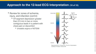 Copyright
©
2023
by
Jones
&
Bartlett
Learning,
LLC,
an
Ascend
Learning
Company
and
the
American
Academy
of
Orthopaedic
Surgeons.
Approach to the 12-lead ECG Interpretation (18 of 33)
 Review for zones of ischemia,
injury, and infarction (cont’d)
 ST-segment depression greater
than 0.5 mm in two or more
contiguous leads in a patient with
chest pain or discomfort
 Unstable angina or NSTEMI
Reproduced from 12-Lead ECG: The Art of Interpretation,
courtesy of Tomas B. Garcia, MD
 