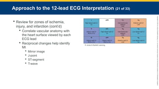 Copyright
©
2023
by
Jones
&
Bartlett
Learning,
LLC,
an
Ascend
Learning
Company
and
the
American
Academy
of
Orthopaedic
Surgeons.
Approach to the 12-lead ECG Interpretation (21 of 33)
 Review for zones of ischemia,
injury, and infarction (cont’d)
 Correlate vascular anatomy with
the heart surface viewed by each
ECG lead
 Reciprocal changes help identify
MI
 Mirror image
 J-point
 ST-segment
 T-wave
© Jones & Bartlett Learning.
 
