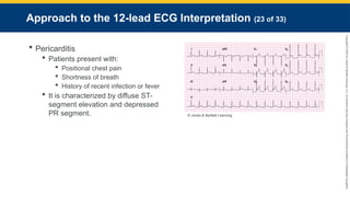 Copyright
©
2023
by
Jones
&
Bartlett
Learning,
LLC,
an
Ascend
Learning
Company
and
the
American
Academy
of
Orthopaedic
Surgeons.
Approach to the 12-lead ECG Interpretation (23 of 33)
 Pericarditis
 Patients present with:
 Positional chest pain
 Shortness of breath
 History of recent infection or fever
 It is characterized by diffuse ST-
segment elevation and depressed
PR segment. © Jones & Bartlett Learning.
 