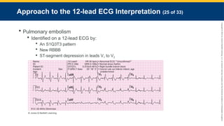Copyright
©
2023
by
Jones
&
Bartlett
Learning,
LLC,
an
Ascend
Learning
Company
and
the
American
Academy
of
Orthopaedic
Surgeons.
Approach to the 12-lead ECG Interpretation (25 of 33)
 Pulmonary embolism
 Identified on a 12-lead ECG by:
 An S1Q3T3 pattern
 New RBBB
 ST-segment depression in leads V1 to V3
© Jones & Bartlett Learning.
 