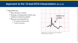 Copyright
©
2023
by
Jones
&
Bartlett
Learning,
LLC,
an
Ascend
Learning
Company
and
the
American
Academy
of
Orthopaedic
Surgeons.
Approach to the 12-lead ECG Interpretation (26 of 33)
 Hypothermia
 May develop J waves
 Reveals a bradycardic rhythm and
baseline containing artifact
 May be accompanied by:
 ST-segment depression
 T-wave inversion
Reproduced from 12-Lead ECG: The Art of Interpretation,
courtesy of Tomas B. Garcia, MD.
 