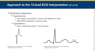 Copyright
©
2023
by
Jones
&
Bartlett
Learning,
LLC,
an
Ascend
Learning
Company
and
the
American
Academy
of
Orthopaedic
Surgeons.
Approach to the 12-lead ECG Interpretation (27 of 33)
 Electrolyte imbalances
 Hyperkalemia
 Tall, peaked, asymmetric T waves with flattened P wave
 Wide QRS complexes in severe cases
 Hypokalemia
 Flat or seemingly absent T and U waves
Reproduced from 12-Lead ECG: The Art of Interpretation,
courtesy of Tomas B. Garcia, MD.
Reproduced from 12-Lead ECG: The Art of Interpretation,
courtesy of Tomas B. Garcia, MD
 