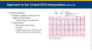 Copyright
©
2023
by
Jones
&
Bartlett
Learning,
LLC,
an
Ascend
Learning
Company
and
the
American
Academy
of
Orthopaedic
Surgeons.
Approach to the 12-lead ECG Interpretation (29 of 33)
 Cardiomyopathy
 Dilated, weakens muscle and its
ability to pump blood
 Heart enlarges and stretched
 Hypertrophic
 Myocardial walls thicken
 Genetic
 Patients experience shortness of
breath, chest pain, and syncope
© Jones & Bartlett Learning.
 