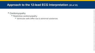 Copyright
©
2023
by
Jones
&
Bartlett
Learning,
LLC,
an
Ascend
Learning
Company
and
the
American
Academy
of
Orthopaedic
Surgeons.
Approach to the 12-lead ECG Interpretation (30 of 33)
 Cardiomyopathy
 Restrictive cardiomyopathy
 Ventricular walls stiffen due to abnormal substances
 