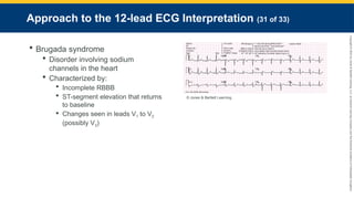 Copyright
©
2023
by
Jones
&
Bartlett
Learning,
LLC,
an
Ascend
Learning
Company
and
the
American
Academy
of
Orthopaedic
Surgeons.
Approach to the 12-lead ECG Interpretation (31 of 33)
 Brugada syndrome
 Disorder involving sodium
channels in the heart
 Characterized by:
 Incomplete RBBB
 ST-segment elevation that returns
to baseline
 Changes seen in leads V1 to V2
(possibly V3)
© Jones & Bartlett Learning.
 