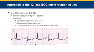 Copyright
©
2023
by
Jones
&
Bartlett
Learning,
LLC,
an
Ascend
Learning
Company
and
the
American
Academy
of
Orthopaedic
Surgeons.
Approach to the 12-lead ECG Interpretation (32 of 33)
 Long QT syndrome (LQTS)
 QT interval exceeding 0.44 second
 Result of:
 Genetic mutation of several genes
 Administration of certain drugs
 Conditions such as hypocalcemia, AMI, or pericarditis
Reproduced from Arrhythmia Recognition: The Art of Interpretation, courtesy of Tomas B. Garcia, MD
 