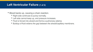 Copyright
©
2023
by
Jones
&
Bartlett
Learning,
LLC,
an
Ascend
Learning
Company
and
the
American
Academy
of
Orthopaedic
Surgeons.
Left Ventricular Failure (1 of 2)
 Blood backs up, causing a chain reaction.
 Right side continues to pump normally.
 Left side cannot keep up, and pressure increases.
 Fluid is forced into alveoli and forms a pulmonary edema.
 Buildup of fluid widens the gap between the alveoli/capillary membrane.
 