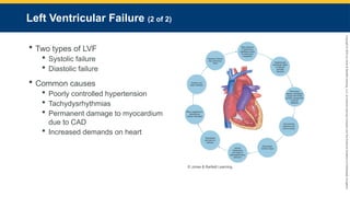 Copyright
©
2023
by
Jones
&
Bartlett
Learning,
LLC,
an
Ascend
Learning
Company
and
the
American
Academy
of
Orthopaedic
Surgeons.
Left Ventricular Failure (2 of 2)
 Two types of LVF
 Systolic failure
 Diastolic failure
 Common causes
 Poorly controlled hypertension
 Tachydysrhythmias
 Permanent damage to myocardium
due to CAD
 Increased demands on heart
© Jones & Bartlett Learning.
 