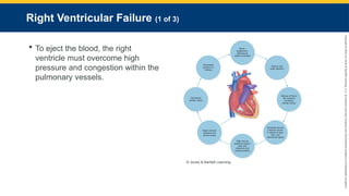 Copyright
©
2023
by
Jones
&
Bartlett
Learning,
LLC,
an
Ascend
Learning
Company
and
the
American
Academy
of
Orthopaedic
Surgeons.
Right Ventricular Failure (1 of 3)
 To eject the blood, the right
ventricle must overcome high
pressure and congestion within the
pulmonary vessels.
© Jones & Bartlett Learning.
 