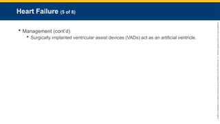 Copyright
©
2023
by
Jones
&
Bartlett
Learning,
LLC,
an
Ascend
Learning
Company
and
the
American
Academy
of
Orthopaedic
Surgeons.
Heart Failure (5 of 8)
 Management (cont’d)
 Surgically implanted ventricular assist devices (VADs) act as an artificial ventricle.
 