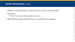 Copyright
©
2023
by
Jones
&
Bartlett
Learning,
LLC,
an
Ascend
Learning
Company
and
the
American
Academy
of
Orthopaedic
Surgeons.
Aortic Aneurysm (1 of 9)
 Dilation or outpouching of a blood vessel or wall of a heart chamber
 Dissection
 Tear in the vessel wall separates into layers
 Blood fills the space between layers, causing them to separate.
 