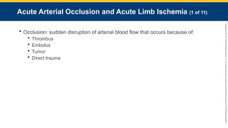 Copyright
©
2023
by
Jones
&
Bartlett
Learning,
LLC,
an
Ascend
Learning
Company
and
the
American
Academy
of
Orthopaedic
Surgeons.
Acute Arterial Occlusion and Acute Limb Ischemia (1 of 11)
 Occlusion: sudden disruption of arterial blood flow that occurs because of:
 Thrombus
 Embolus
 Tumor
 Direct trauma
 