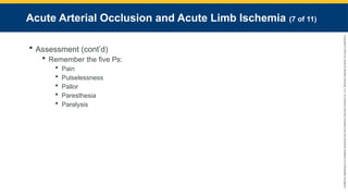 Copyright
©
2023
by
Jones
&
Bartlett
Learning,
LLC,
an
Ascend
Learning
Company
and
the
American
Academy
of
Orthopaedic
Surgeons.
Acute Arterial Occlusion and Acute Limb Ischemia (7 of 11)
 Assessment (cont’d)
 Remember the five Ps:
 Pain
 Pulselessness
 Pallor
 Paresthesia
 Paralysis
 