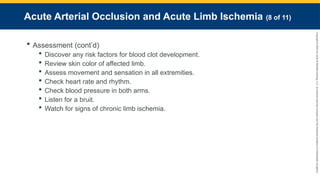 Copyright
©
2023
by
Jones
&
Bartlett
Learning,
LLC,
an
Ascend
Learning
Company
and
the
American
Academy
of
Orthopaedic
Surgeons.
Acute Arterial Occlusion and Acute Limb Ischemia (8 of 11)
 Assessment (cont’d)
 Discover any risk factors for blood clot development.
 Review skin color of affected limb.
 Assess movement and sensation in all extremities.
 Check heart rate and rhythm.
 Check blood pressure in both arms.
 Listen for a bruit.
 Watch for signs of chronic limb ischemia.
 